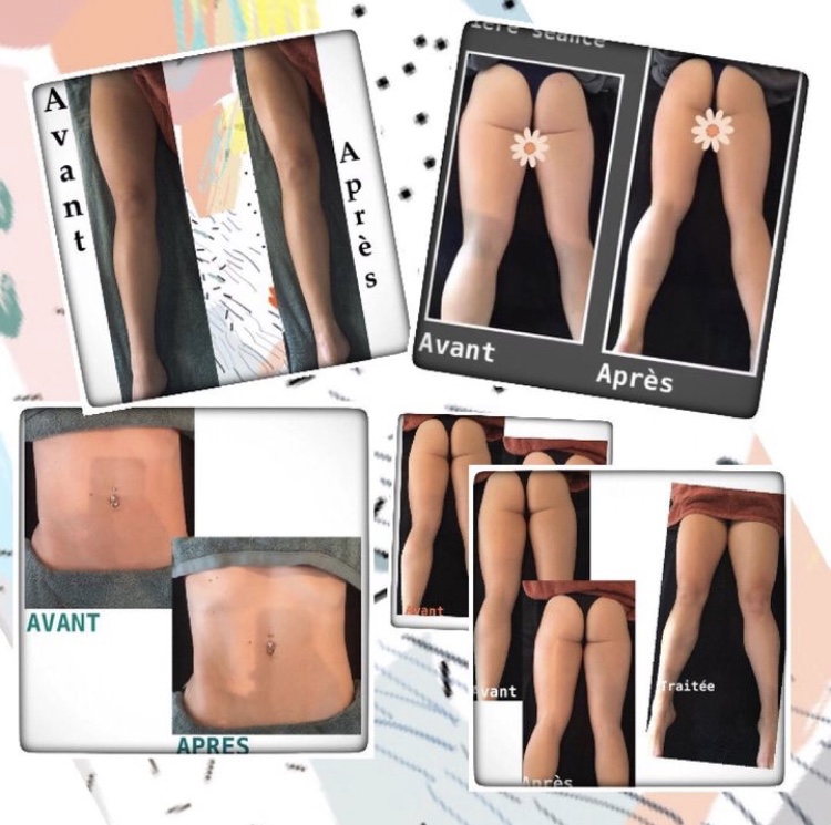 avant apres pour maderotherapie corps