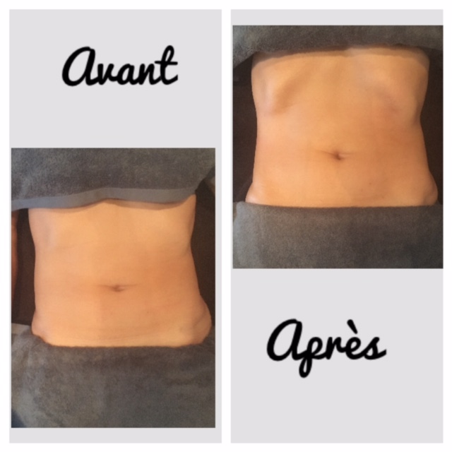 Le drainage lymphatique manuel